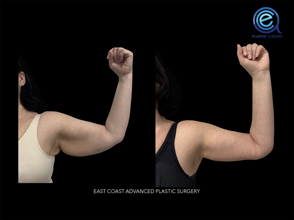Real patient Brachioplasty Arm Lift by ECA Plastic Surgery, New Jersey