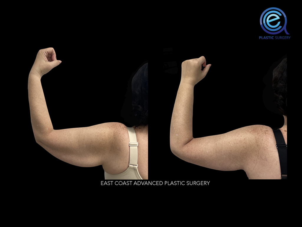 Real patient Brachioplasty Arm Lift by ECA Plastic Surgery, New Jersey