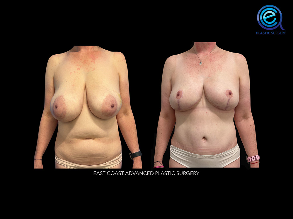 Real patient Breast Reconstruction by ECA Plastic Surgery, New Jersey
