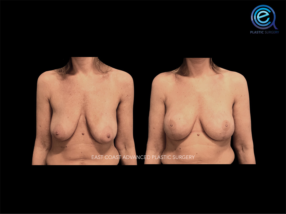 Real patient Breast Reconstruction by ECA Plastic Surgery, New Jersey