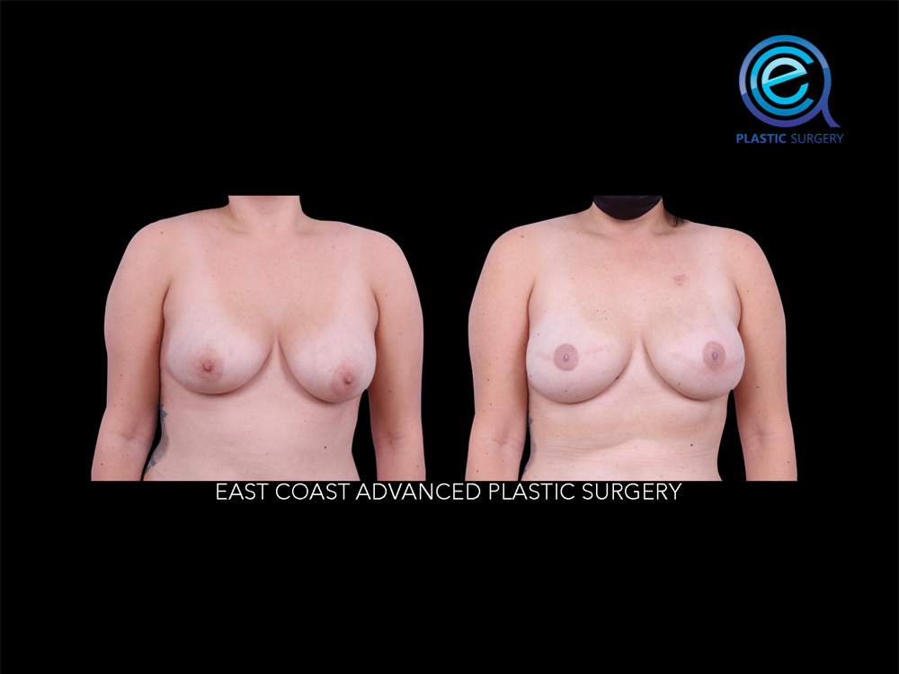 Real patient Breast Reconstruction by ECA Plastic Surgery, New Jersey