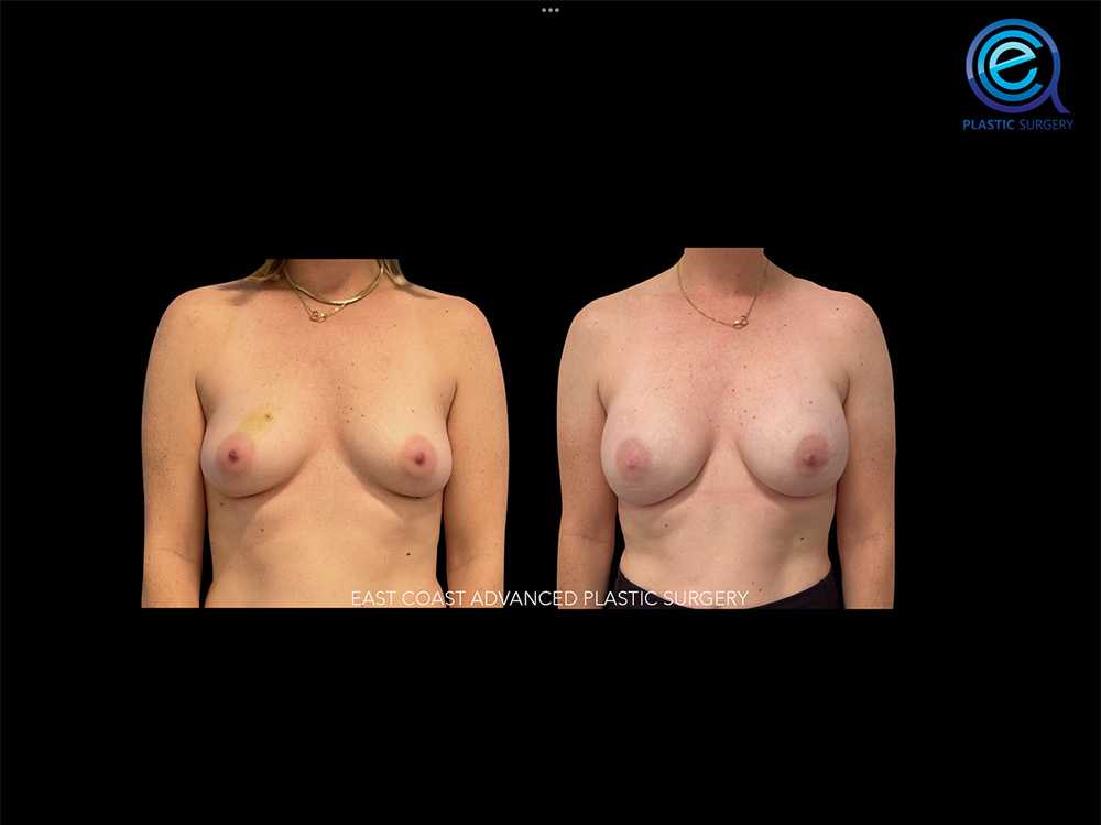 Real patient Breast Reconstruction by ECA Plastic Surgery, New Jersey