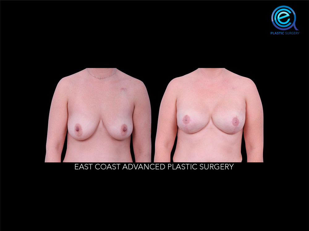 Real patient Breast Reconstruction by ECA Plastic Surgery, New Jersey