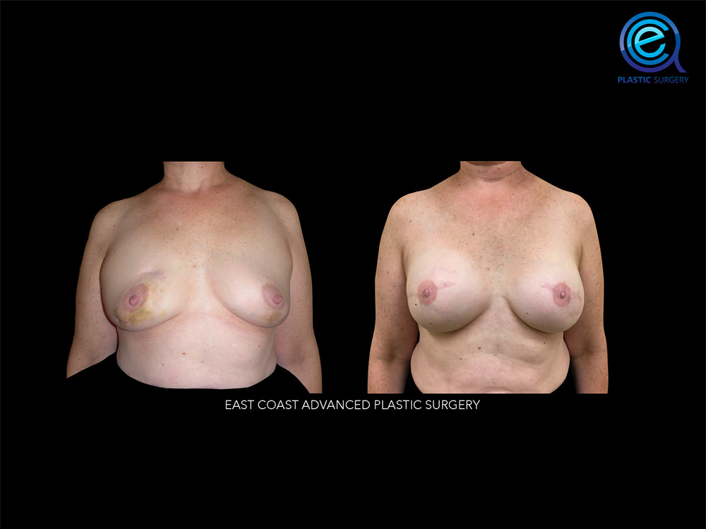Real patient Breast Reconstruction by ECA Plastic Surgery, New Jersey