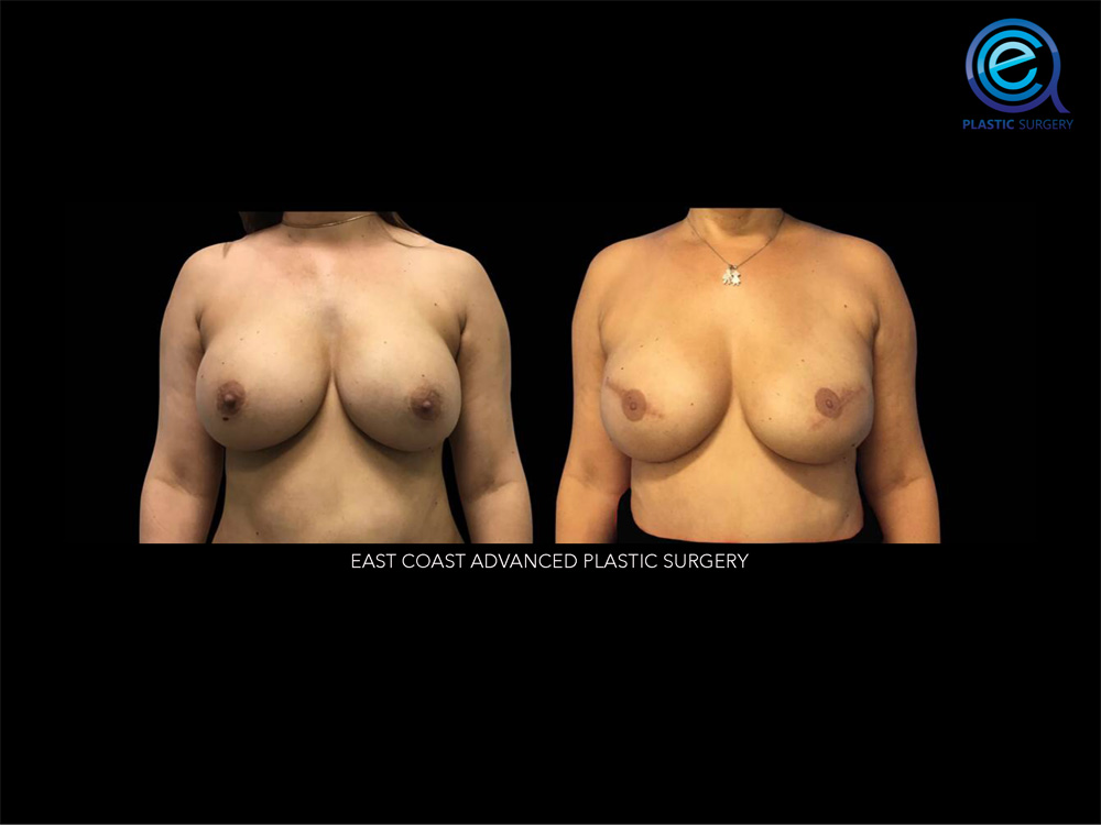 Real patient Breast Reconstruction by ECA Plastic Surgery, New Jersey