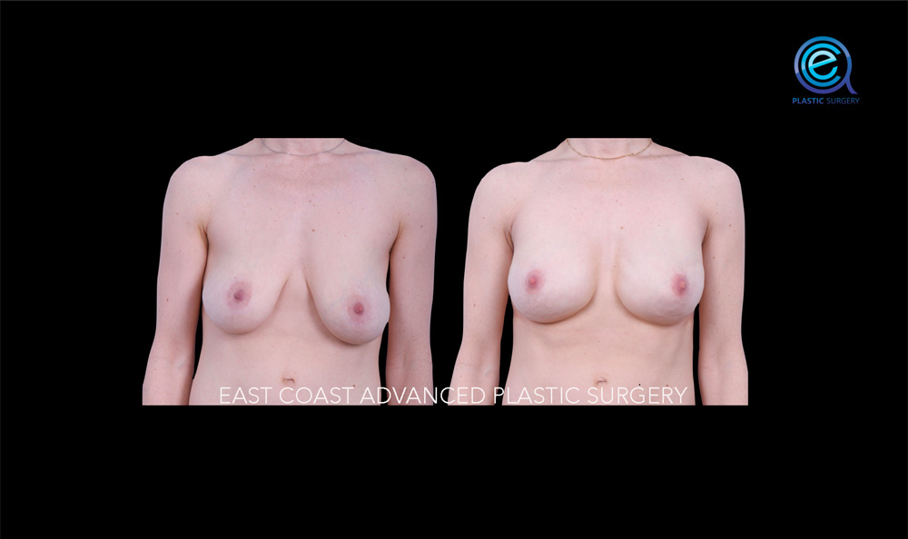 Real patient Breast Reconstruction by ECA Plastic Surgery, New Jersey