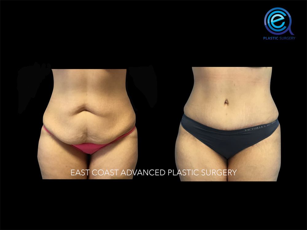 Real patient Abdominoplasty Tummy Tuck by ECA Plastic Surgery, New Jersey