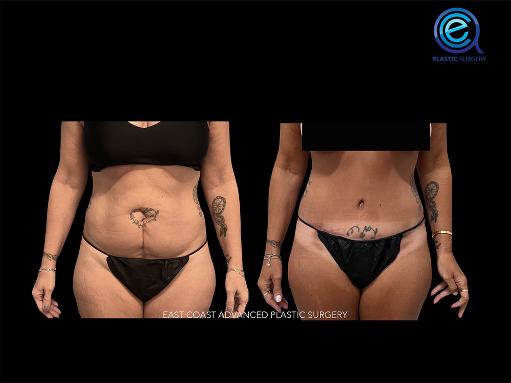 Real patient Abdominoplasty Tummy Tuck by ECA Plastic Surgery, New Jersey