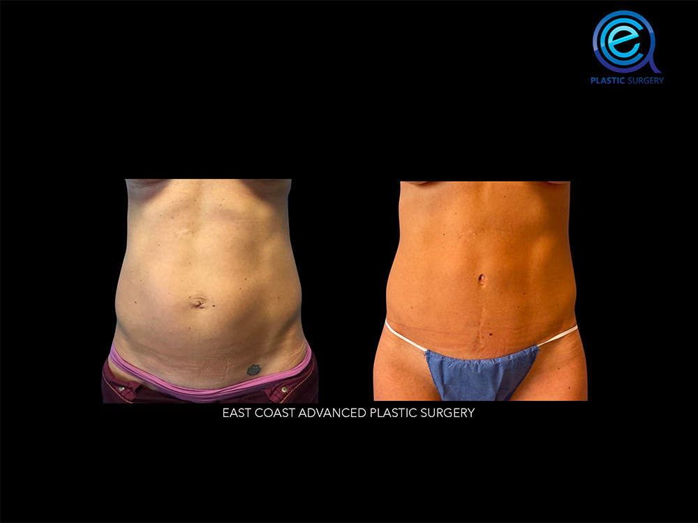 Real patient Abdominoplasty Tummy Tuck by ECA Plastic Surgery, New Jersey