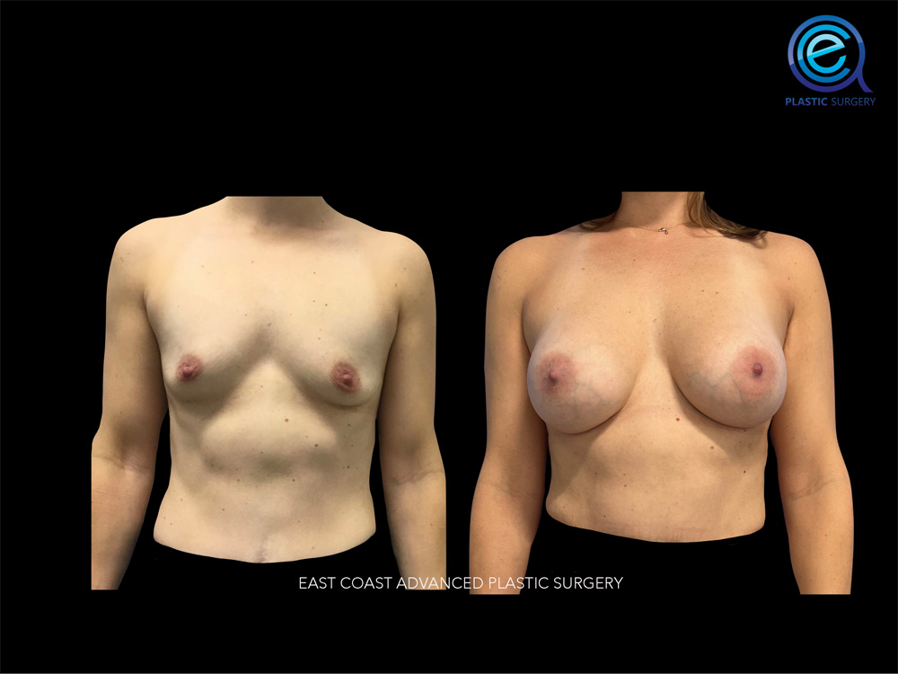 Real patient Breast Augmentation by ECA Plastic Surgery, New Jersey