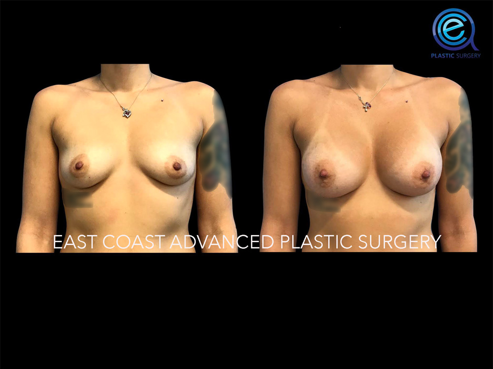 Real patient Breast Augmentation by ECA Plastic Surgery, New Jersey