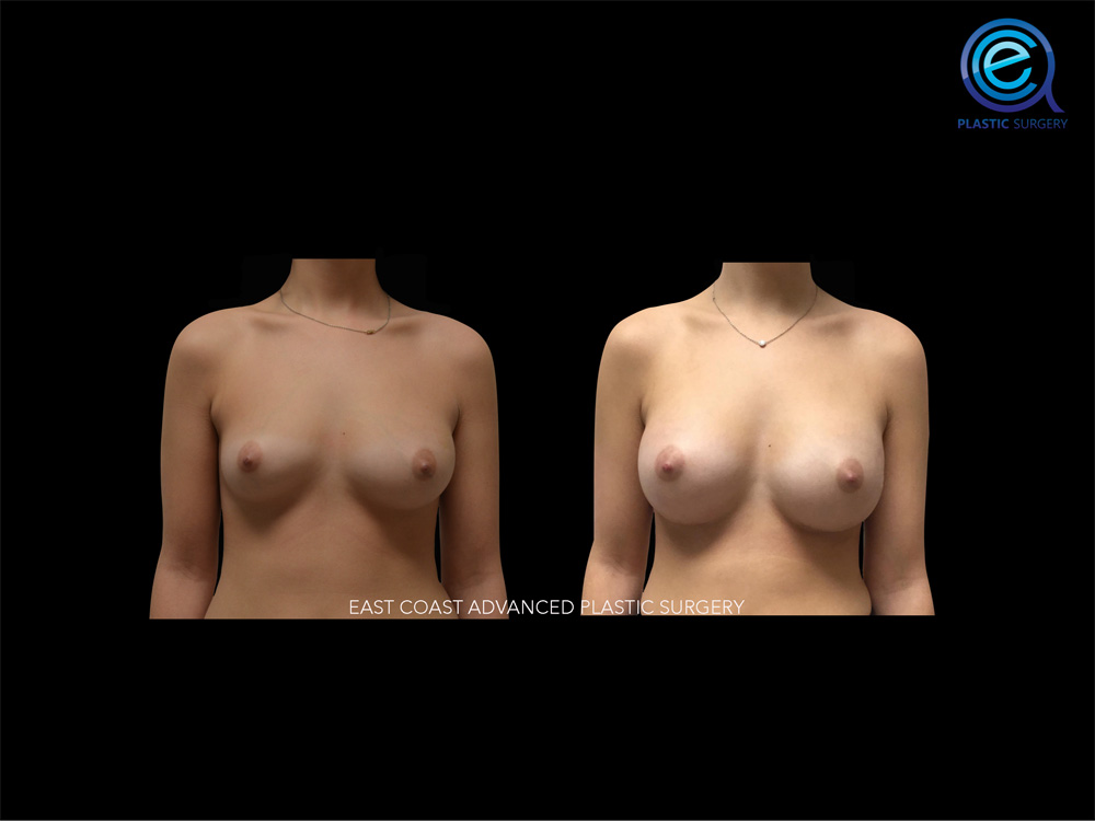 Real patient Breast Augmentation by ECA Plastic Surgery, New Jersey