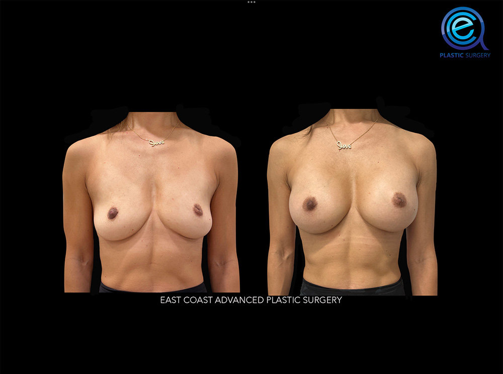 Real patient Breast Augmentation by ECA Plastic Surgery, New Jersey