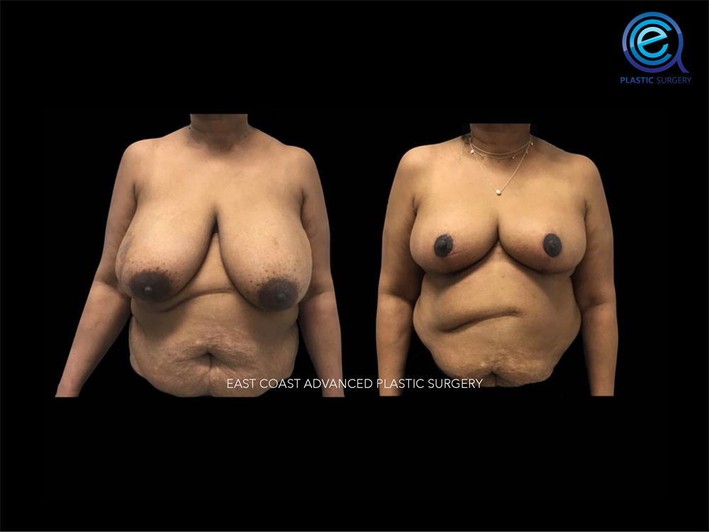 Real patient Breast Reconstruction by ECA Plastic Surgery, New Jersey