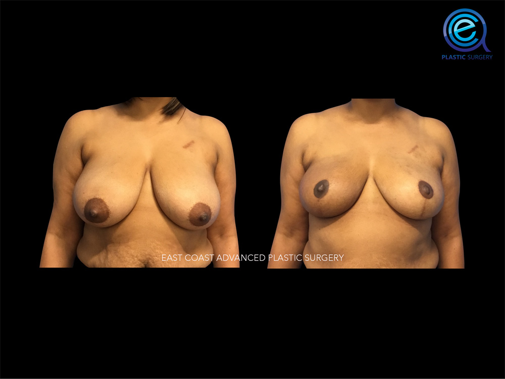 Real patient Breast Reconstruction by ECA Plastic Surgery, New Jersey