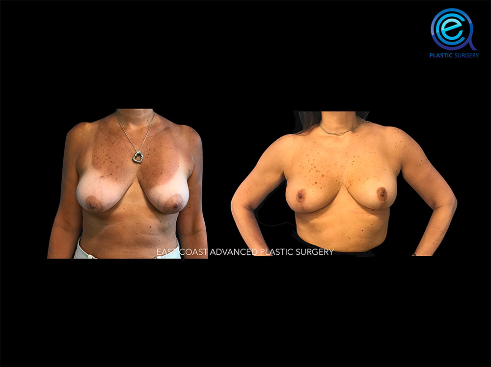 Real patient Breast Reconstruction by ECA Plastic Surgery, New Jersey