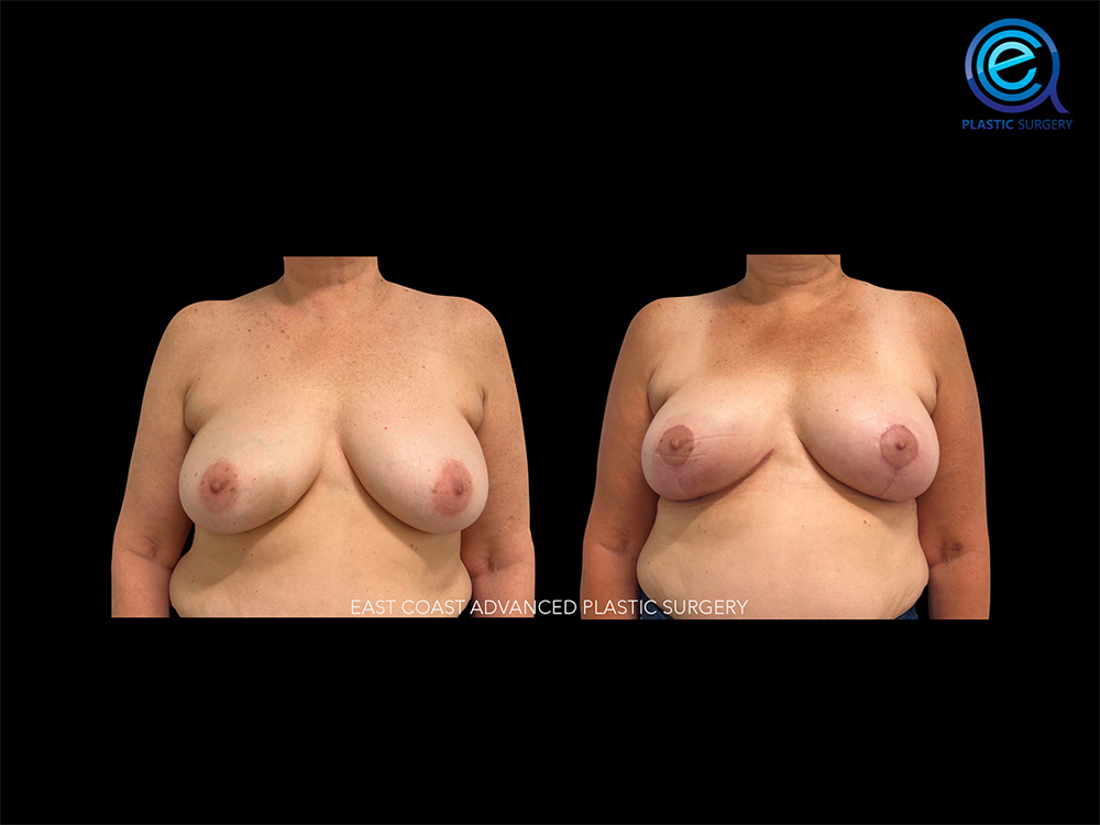 Real patient Breast Reconstruction by ECA Plastic Surgery, New Jersey