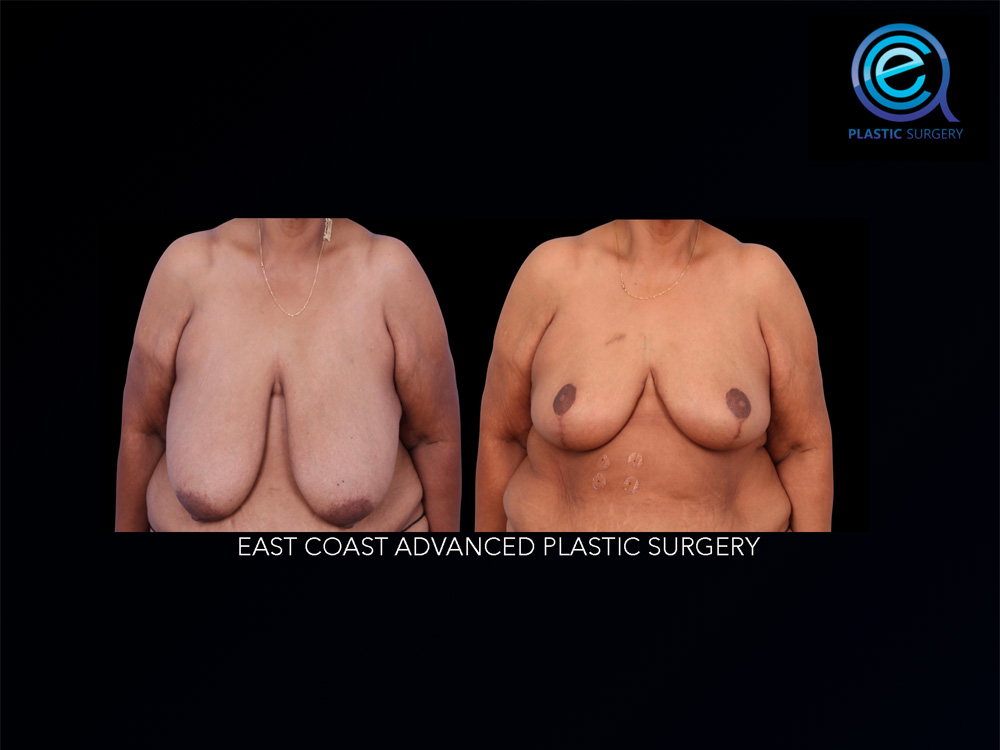 Real patient Breast Reconstruction by ECA Plastic Surgery, New Jersey