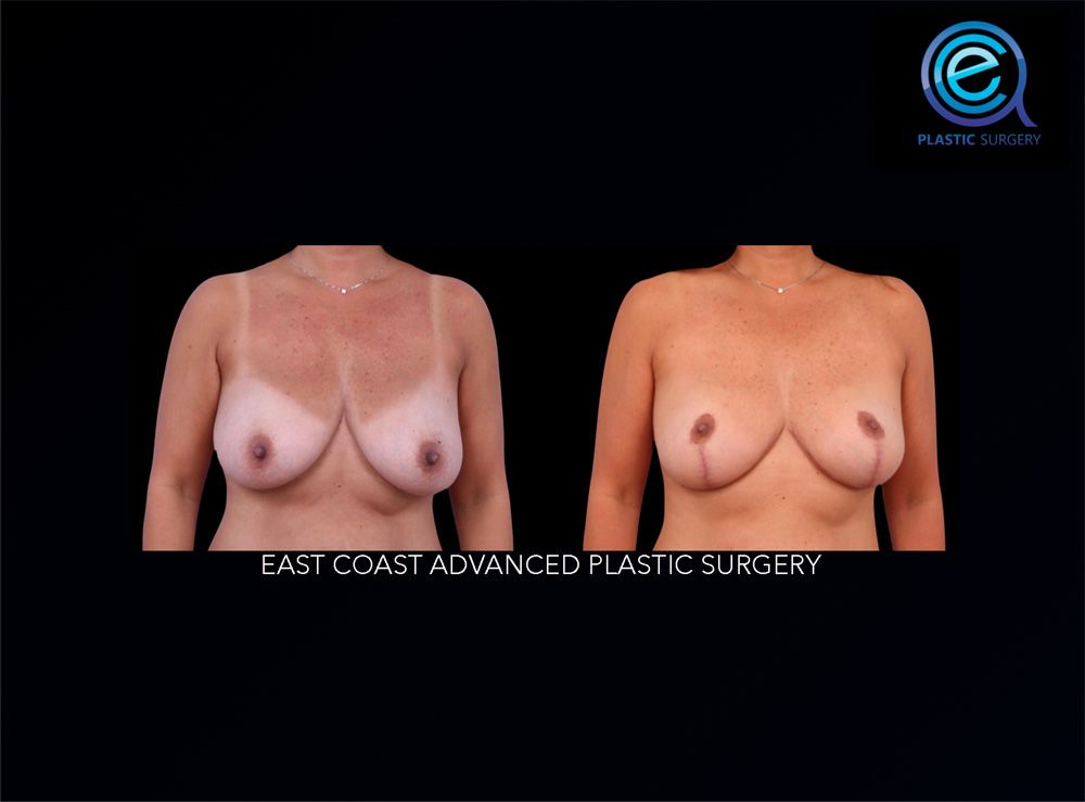 Real patient Breast Reconstruction by ECA Plastic Surgery, New Jersey