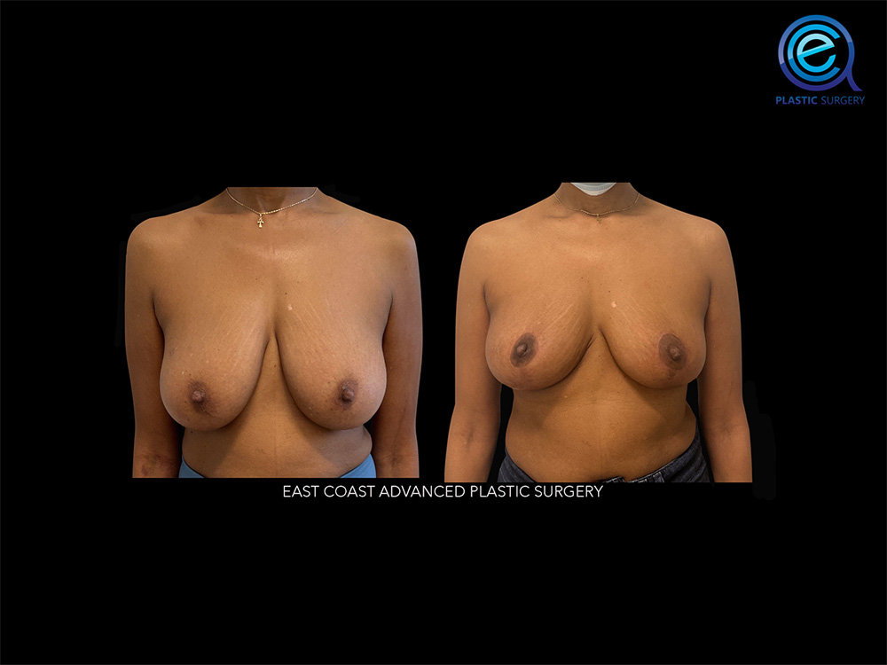 Real patient Breast Reconstruction by ECA Plastic Surgery, New Jersey