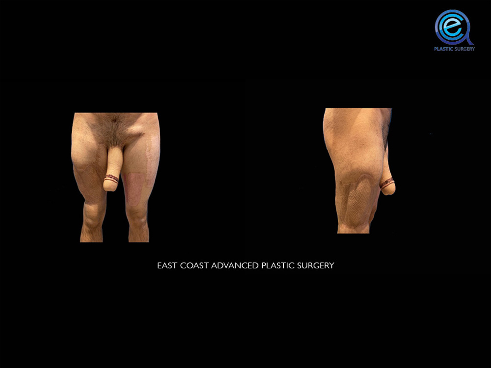 Real patient Phalloplasty by ECA Plastic Surgery, New Jersey
