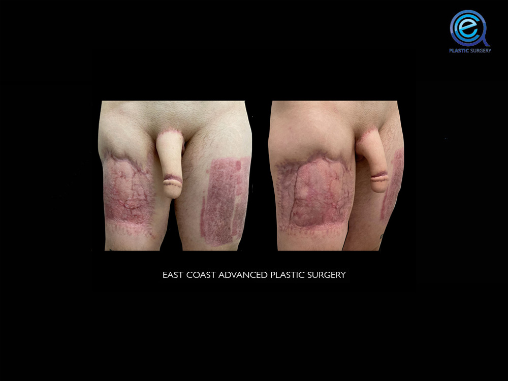 Real patient Phalloplasty by ECA Plastic Surgery, New Jersey