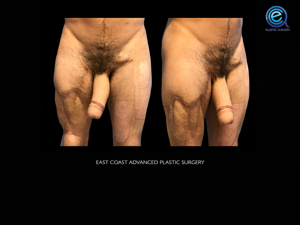 Real patient Phalloplasty by ECA Plastic Surgery, New Jersey
