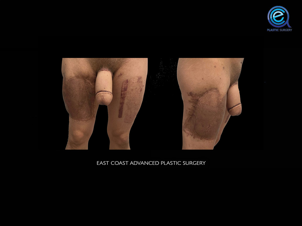 Real patient Phalloplasty by ECA Plastic Surgery, New Jersey