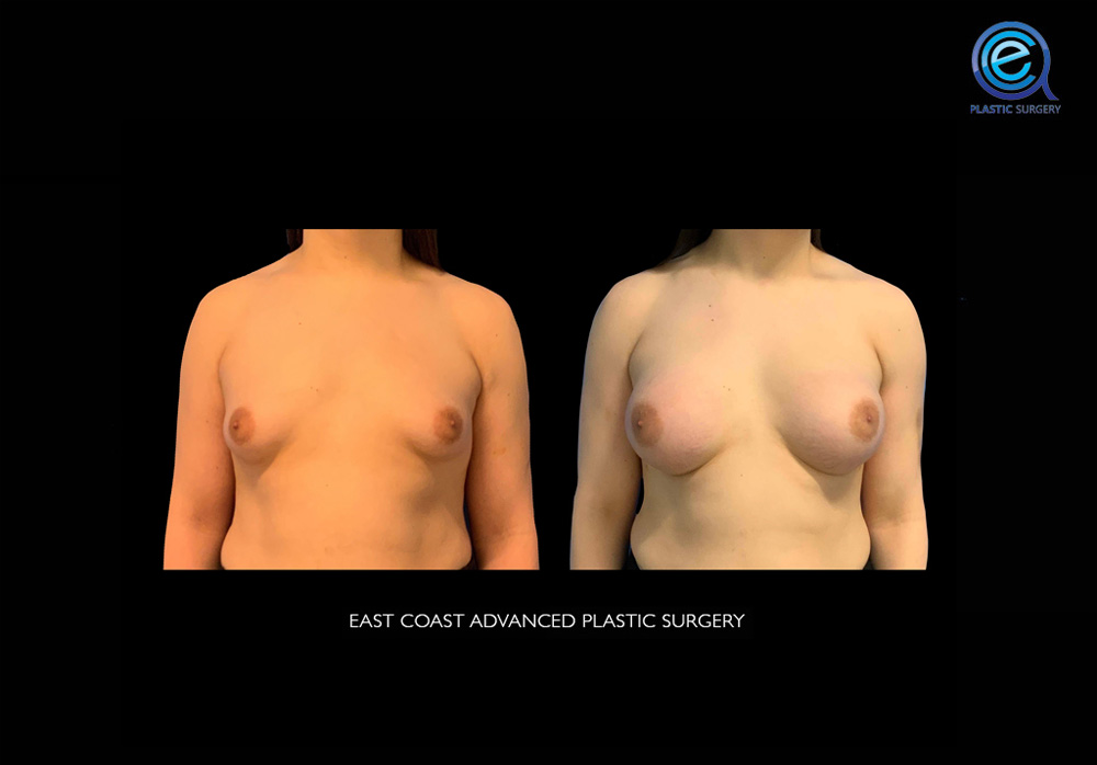 Real patient Chest Feminization by ECA Plastic Surgery, New Jersey