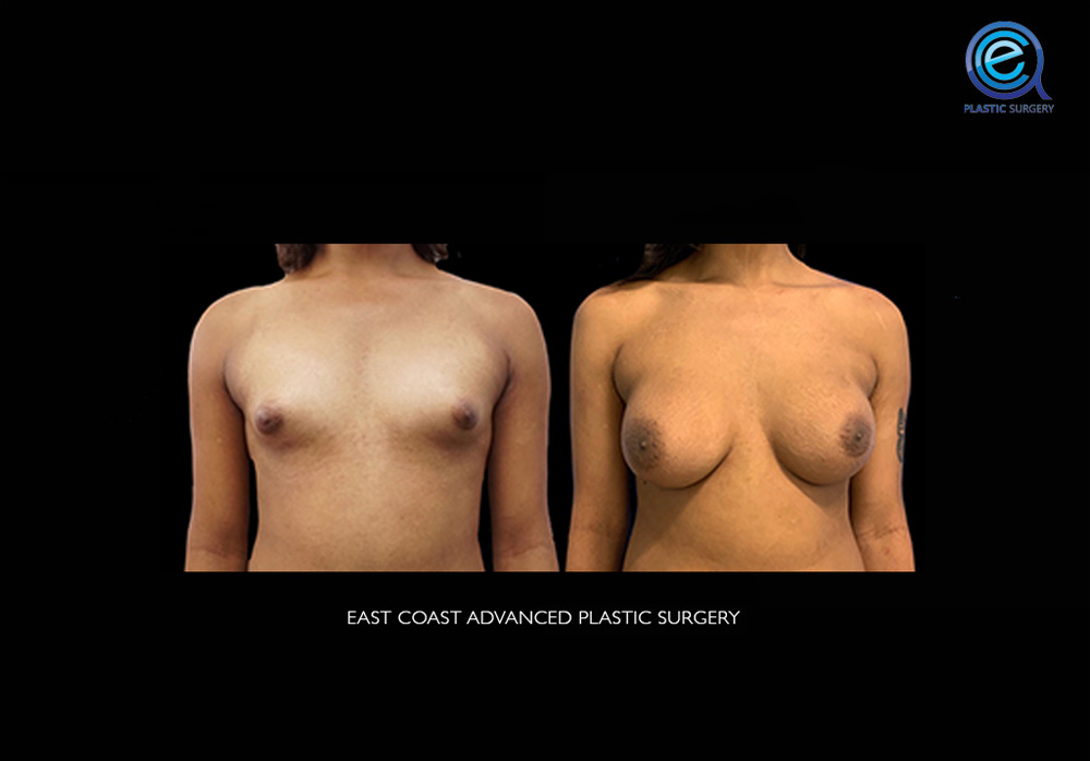 Real patient Chest Feminization by ECA Plastic Surgery, New Jersey