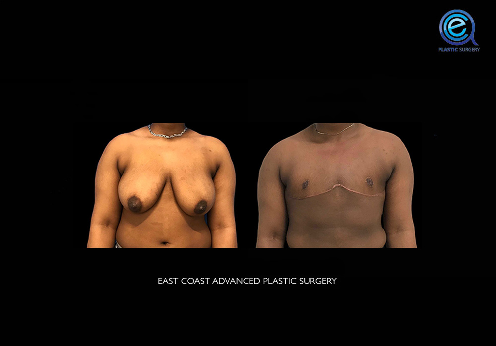 Real patient Chest Masculinization by ECA Plastic Surgery, New Jersey
