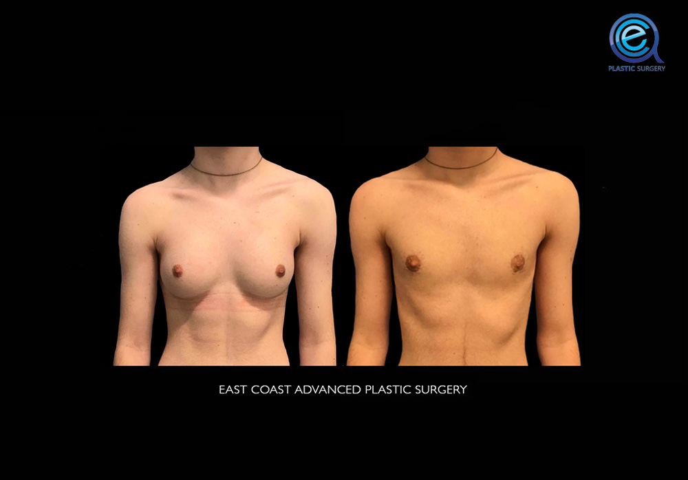 Real patient Chest Masculinization by ECA Plastic Surgery, New Jersey