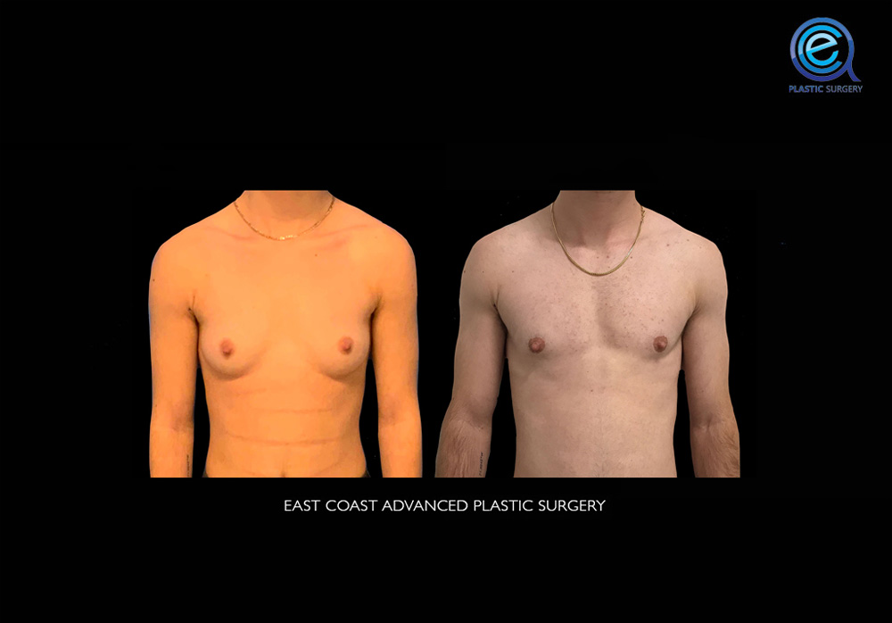 Real patient Chest Masculinization by ECA Plastic Surgery, New Jersey