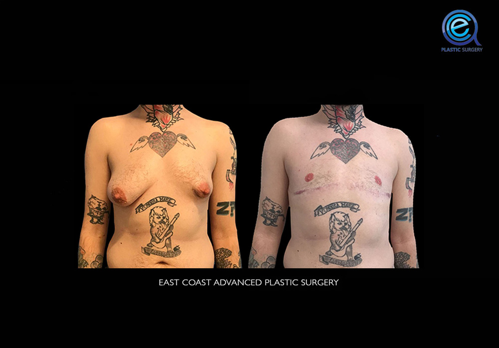 Real patient Chest Masculinization by ECA Plastic Surgery, New Jersey