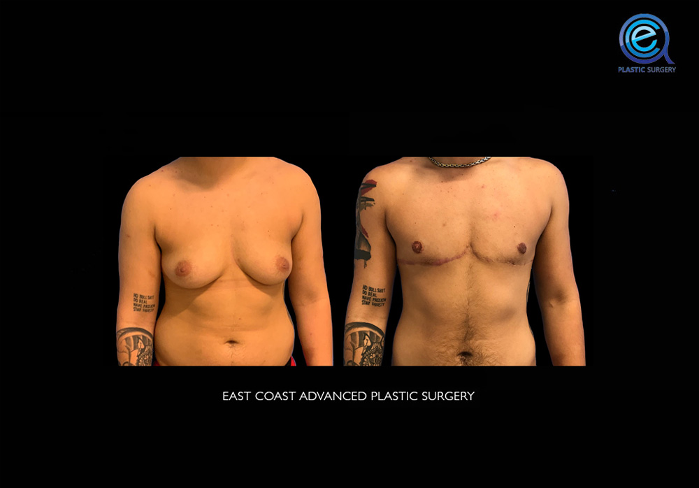 Real patient Chest Masculinization by ECA Plastic Surgery, New Jersey
