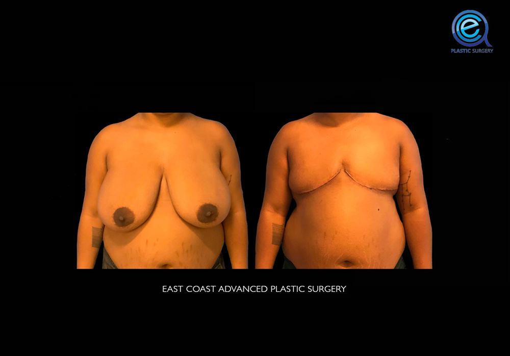Real patient Chest Masculinization by ECA Plastic Surgery, New Jersey