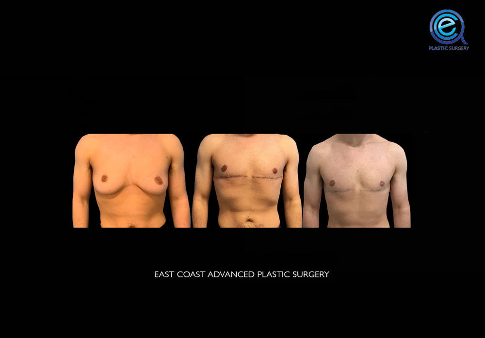 Real patient Chest Masculinization by ECA Plastic Surgery, New Jersey