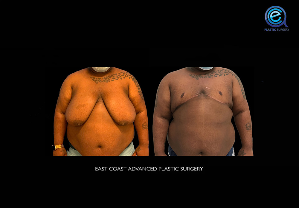 Real patient Chest Masculinization by ECA Plastic Surgery, New Jersey