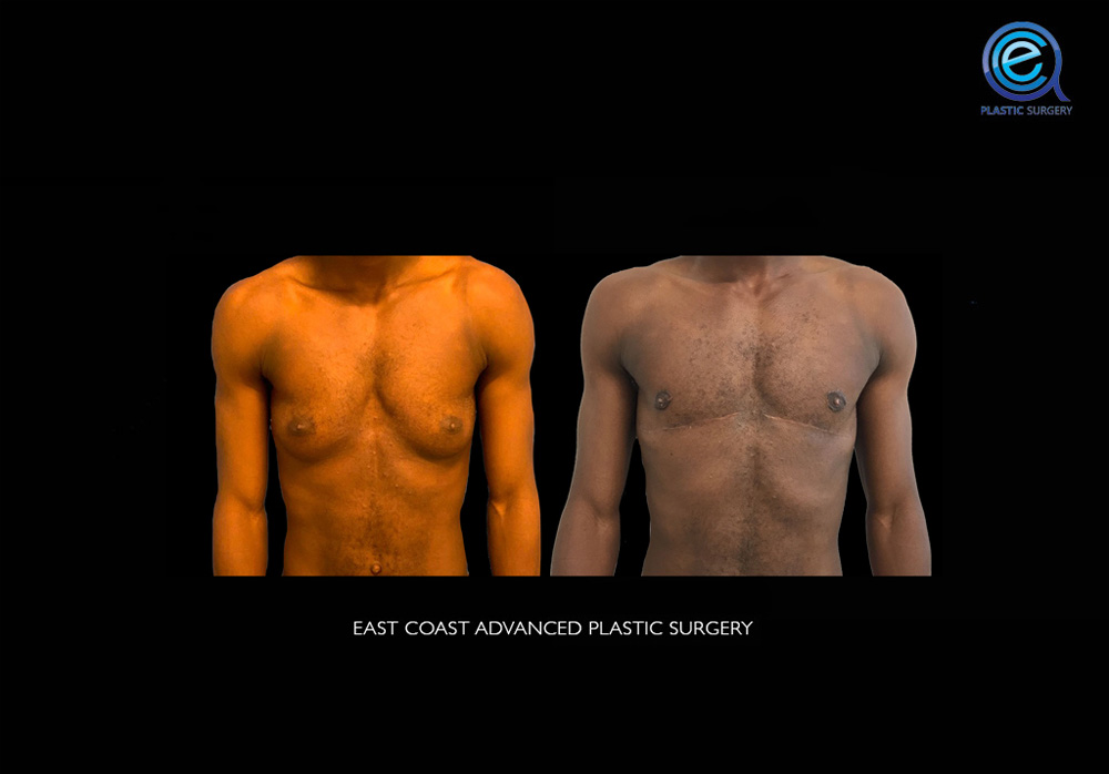 Real patient Chest Masculinization by ECA Plastic Surgery, New Jersey