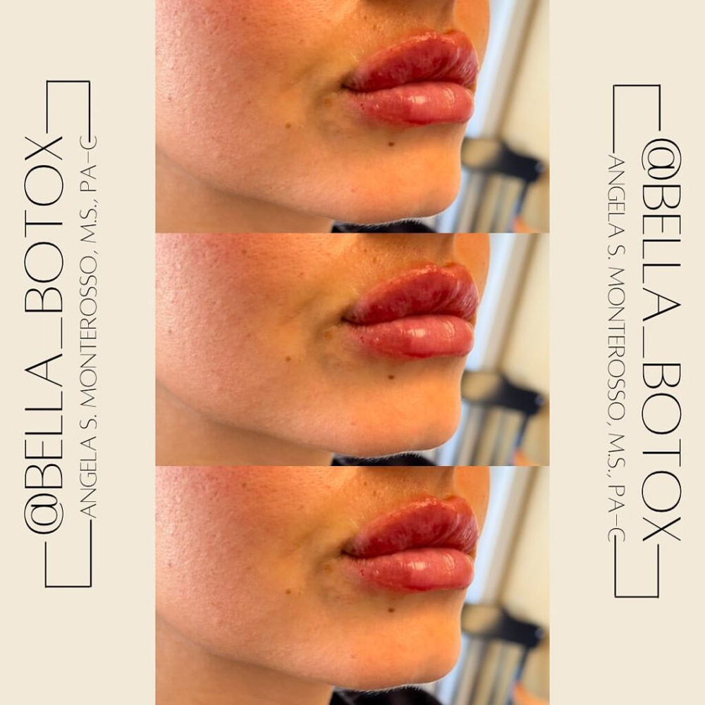 Real patient Lip Augmentation by ECA Plastic Surgery, New Jersey