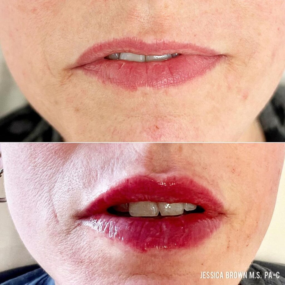 Real patient Lip Augmentation by ECA Plastic Surgery, New Jersey