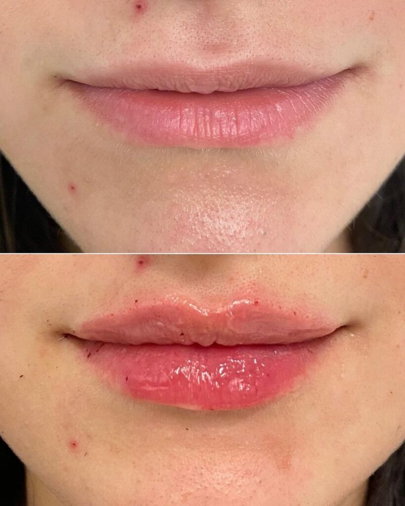 Real patient Lip Augmentation by ECA Plastic Surgery, New Jersey