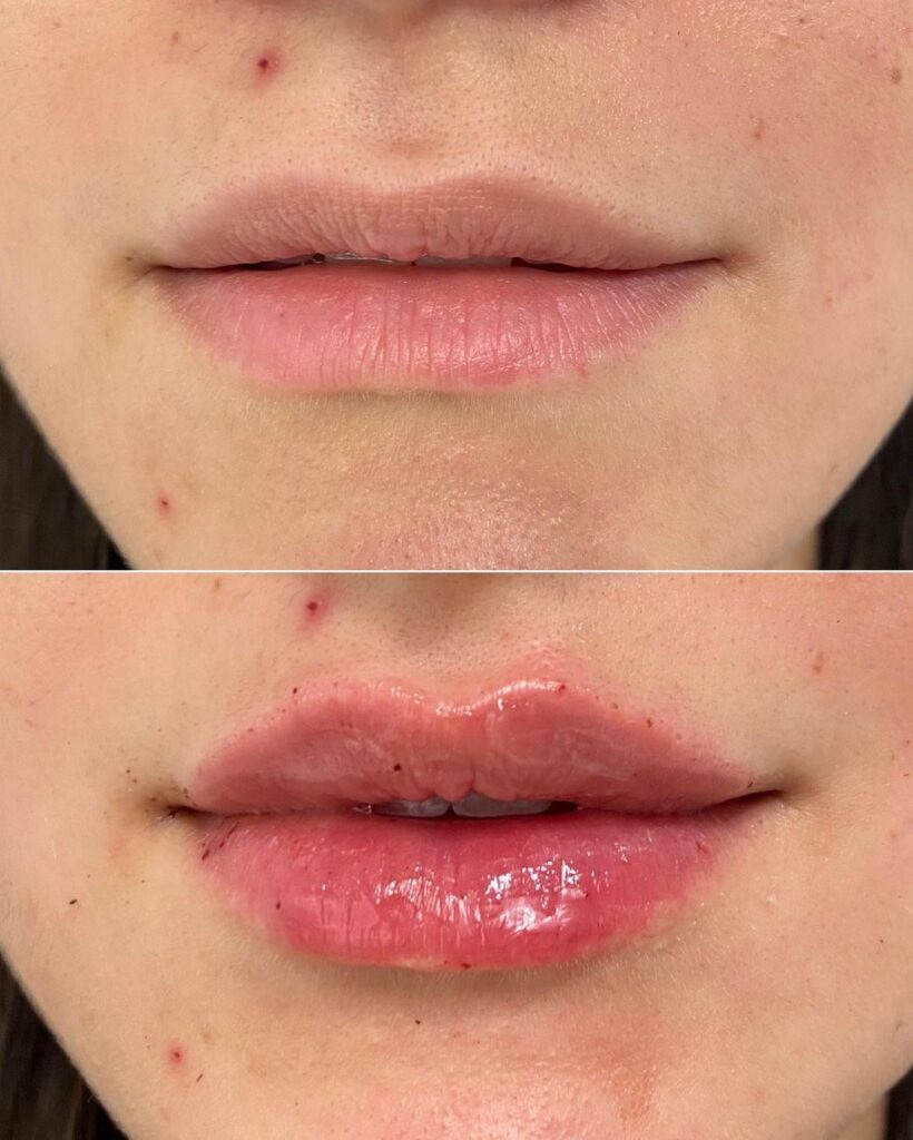 Real patient Lip Augmentation by ECA Plastic Surgery, New Jersey