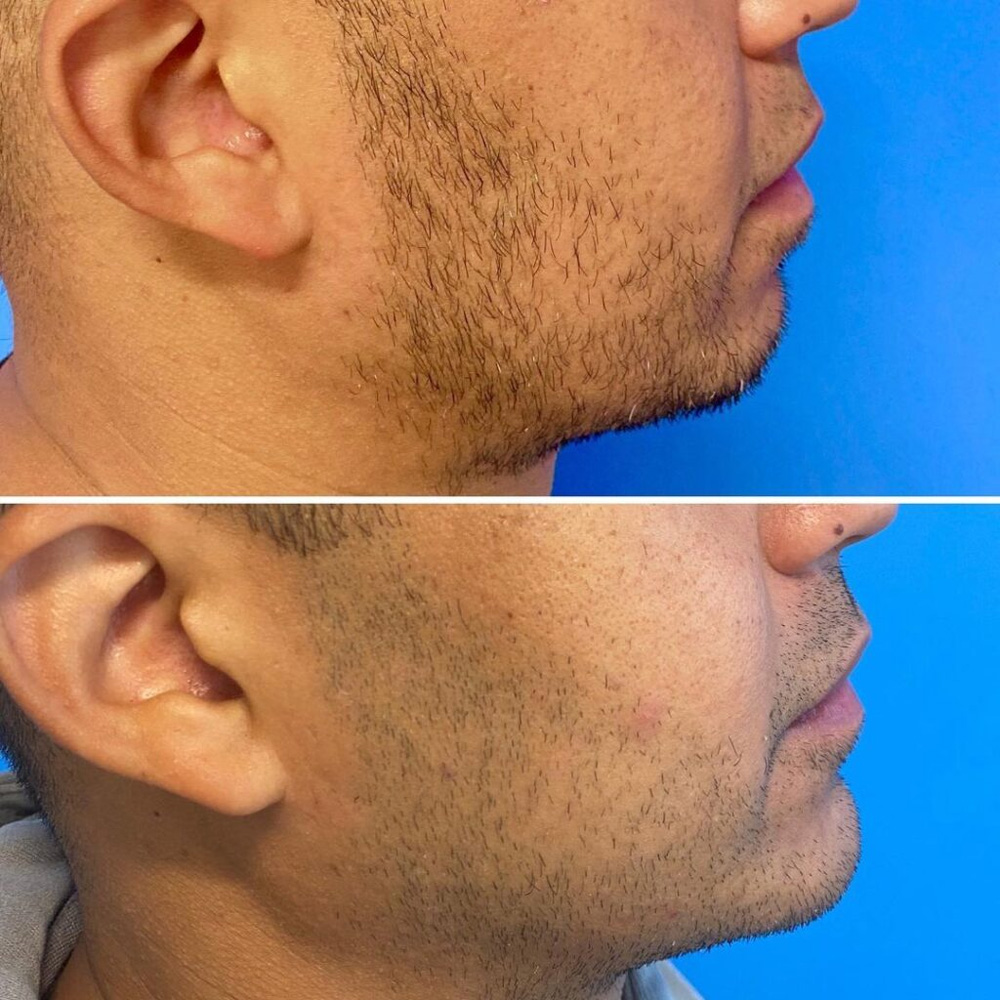 Real patient Lip Augmentation by ECA Plastic Surgery, New Jersey