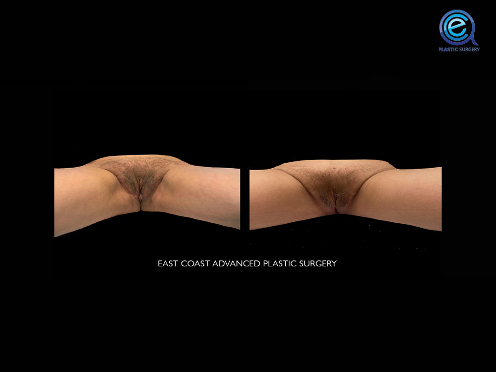 Real patient Vaginoplasty by ECA Plastic Surgery, New Jersey