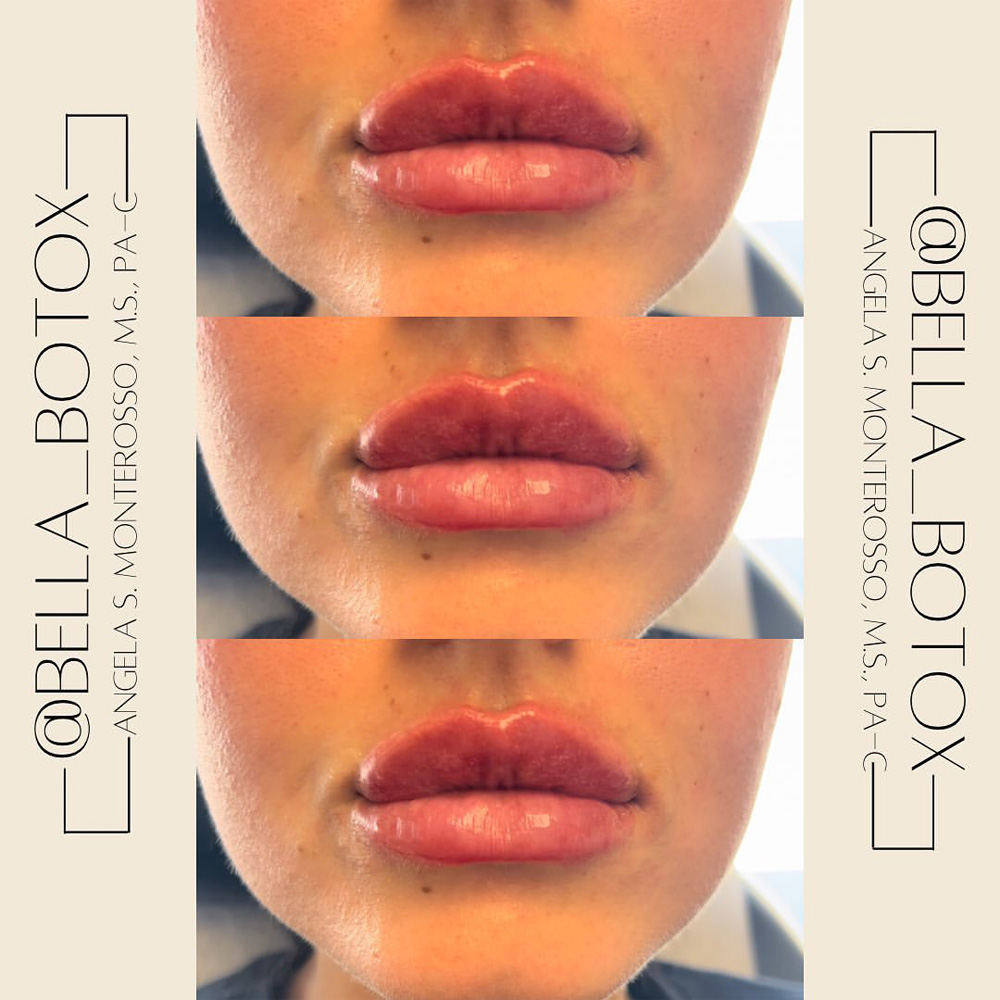 Real patient Lip Augmentation by ECA Plastic Surgery, New Jersey