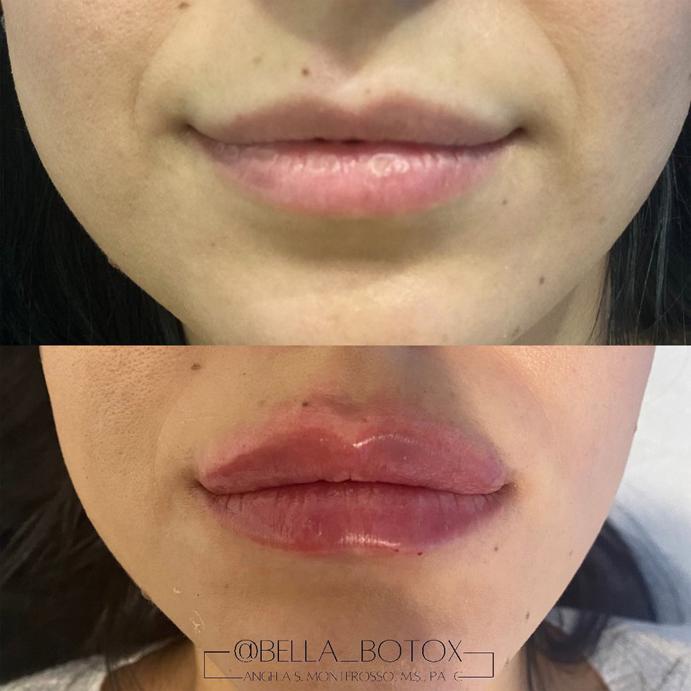 Real patient Lip Augmentation by ECA Plastic Surgery, New Jersey