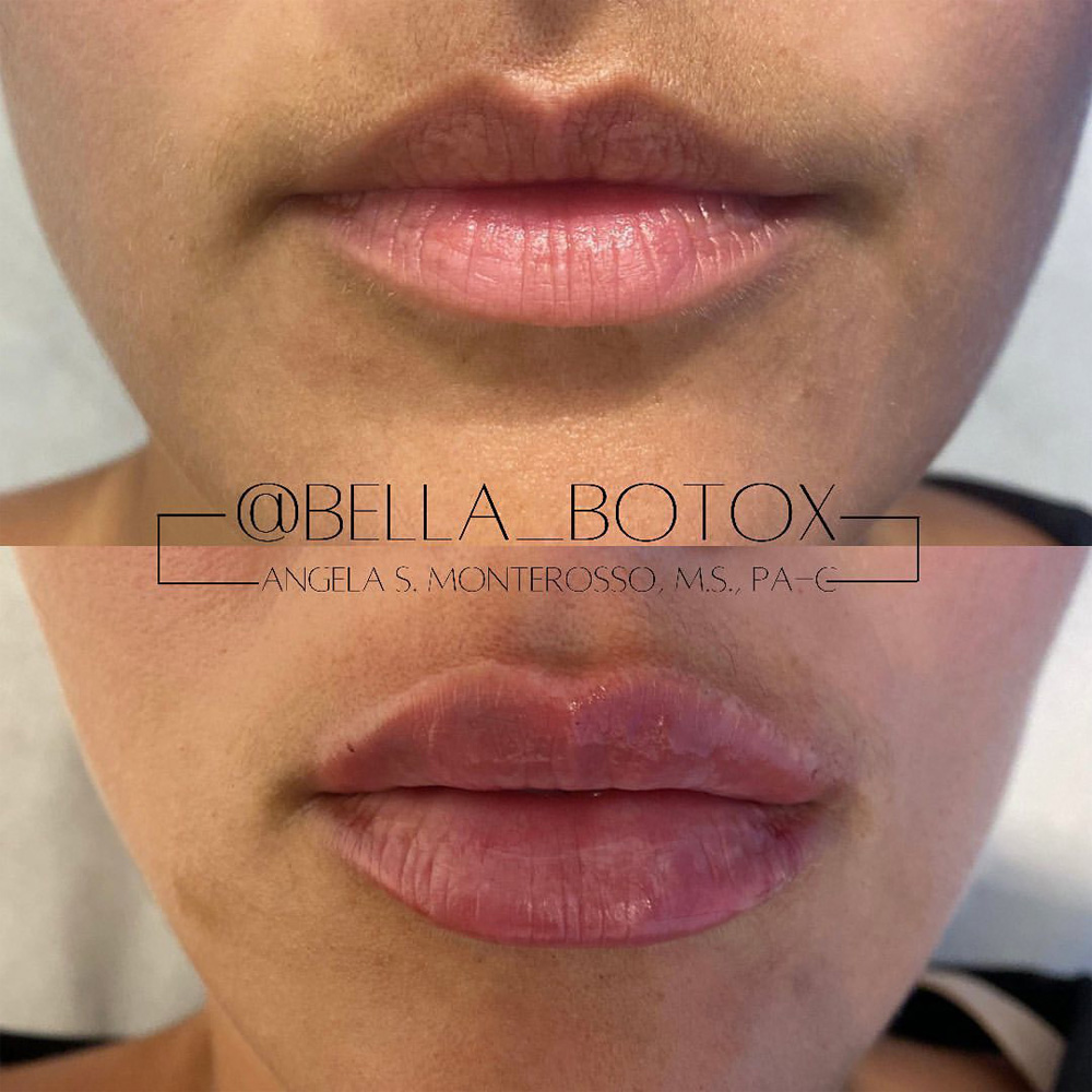 Real patient Lip Augmentation by ECA Plastic Surgery, New Jersey