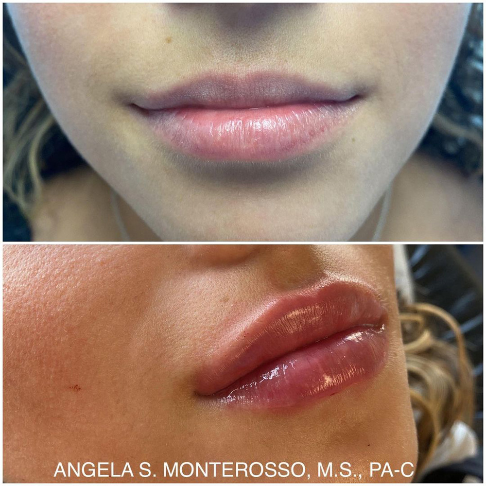 Real patient Lip Augmentation by ECA Plastic Surgery, New Jersey