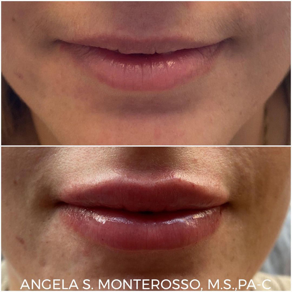 Real patient Lip Augmentation by ECA Plastic Surgery, New Jersey